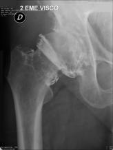 radiographie articulation