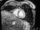 irm cardiaque
