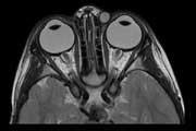irm cerveau 2